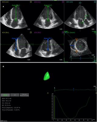 The Role of Four-Dimensional Automatic Right Ventricular Quantification Technology to Determine RV Function and Hemodynamics in Patients With Pulmonary Hypertension Compared With Right Heart Catheterization